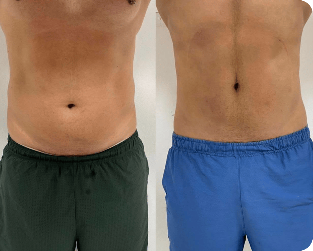 PROTOCOLO ULTRAFORMER (2)