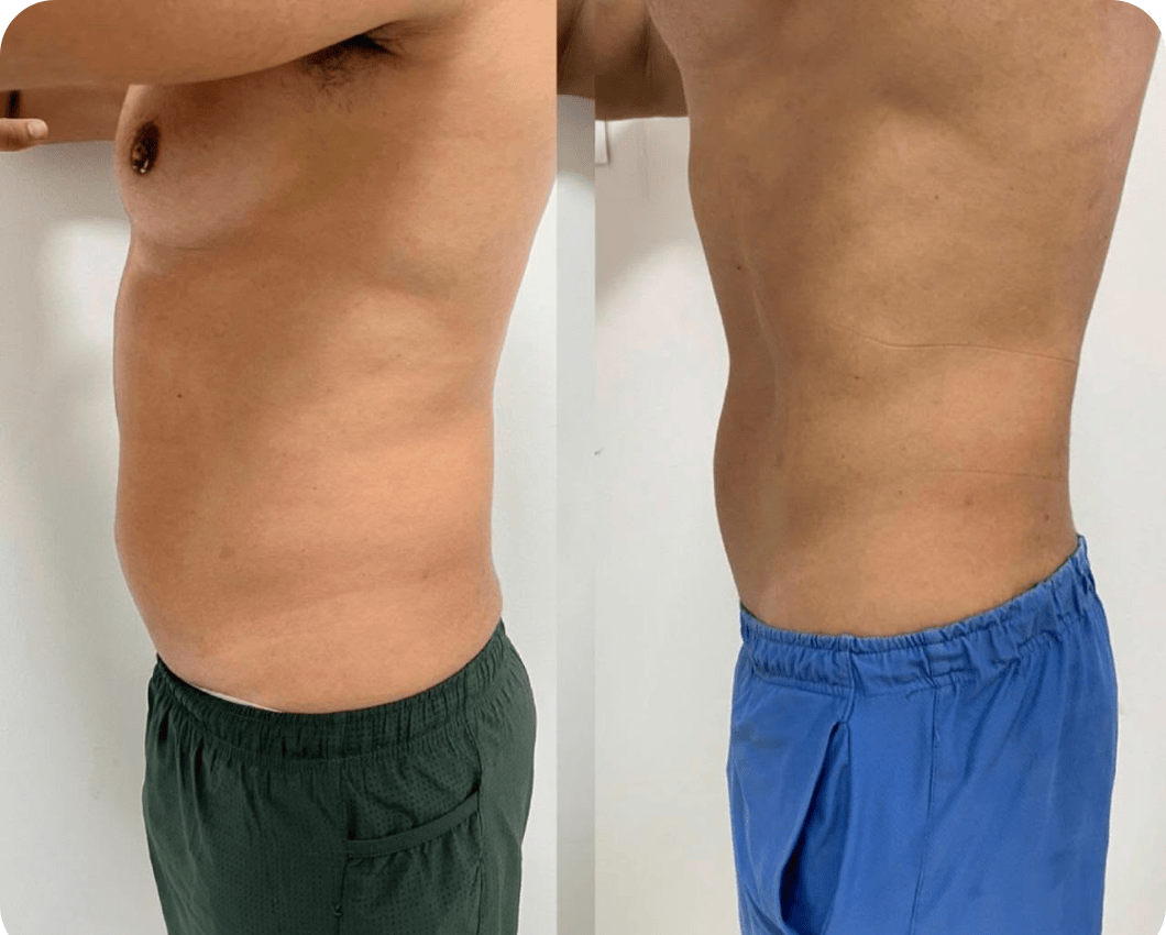 PROTOCOLO ULTRAFORMER (6)