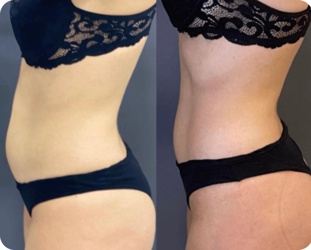 PROTOCOLO ULTRAFORMER